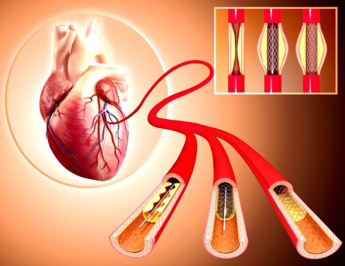 Coronary Angioplasty