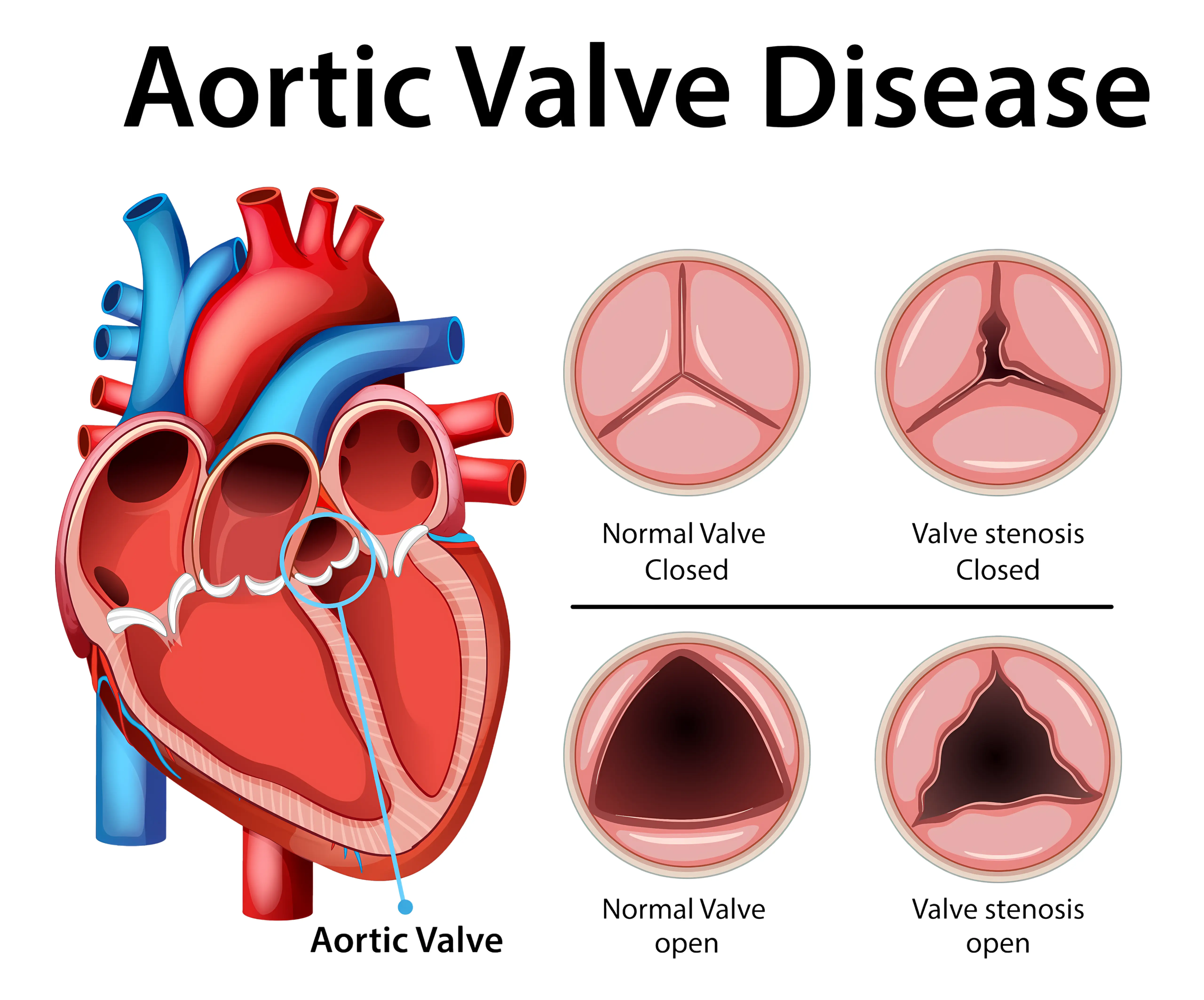 Aortic Valve Replacement Surgery [ AVR ] :
