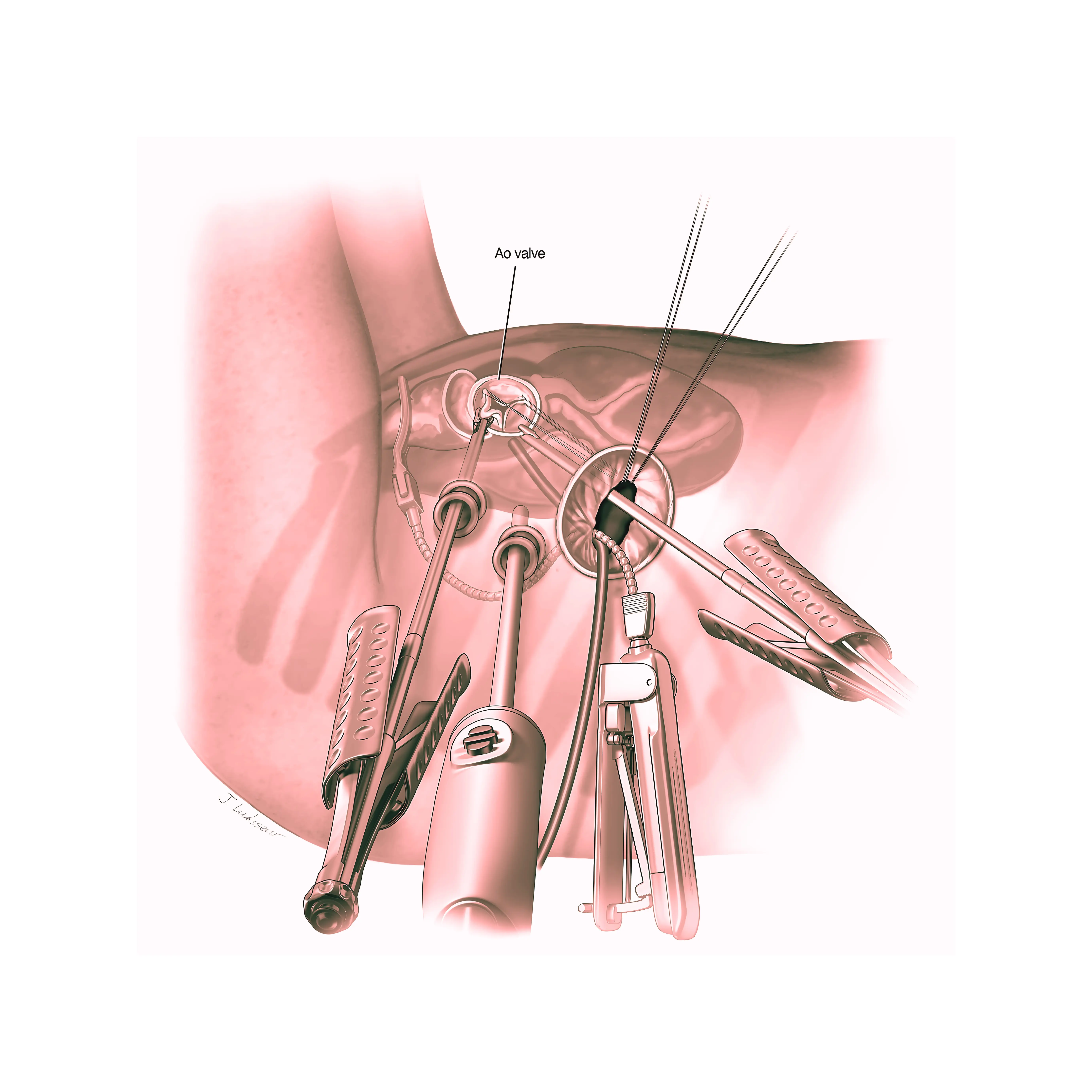 Minimally Invasive Cardiac Surgery [ MICS ] 