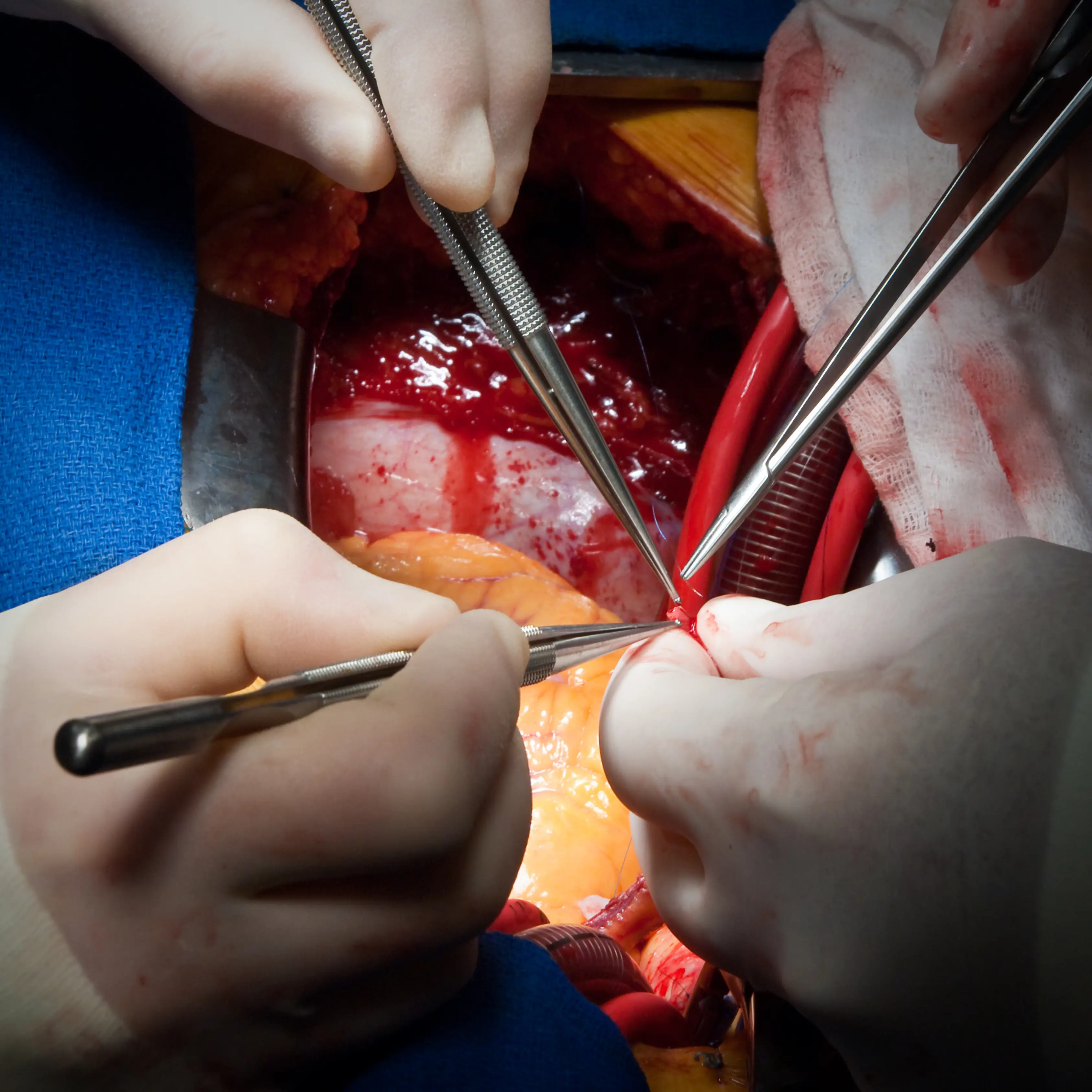 Bypass Heart Surgery